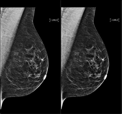 Use of Full-quality DICOM Images Compared to Minimally Compressed Mammograms in JPEG Format for ...