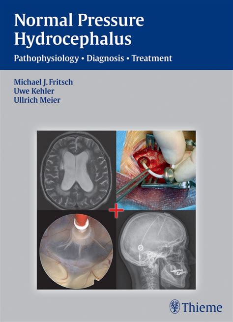 Normal Pressure Hydrocephalus Pathophysiology – Diagnosis – Treatment 1st Edition – PremiumJS Store
