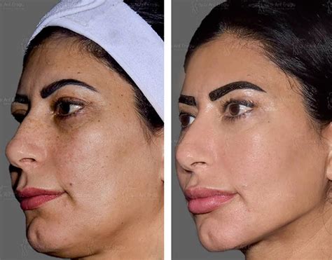 Thread Lift Before and After Photos