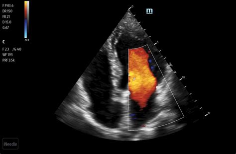 Image result for Mindray Te7 Measurements Tutorial