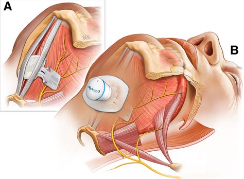 Implantation of the nyxoah bilateral hypoglossal nerve stimulator for ...