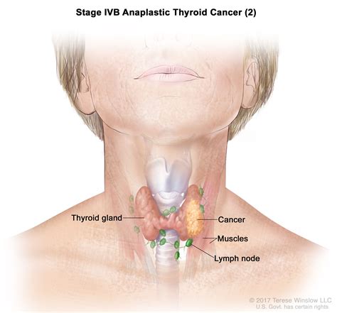 Thyroid Cancer | Cardiothoracic Surgery