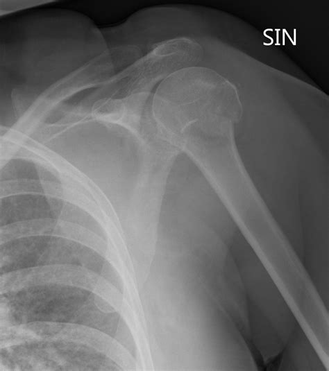 Inferior Shoulder Dislocation X Ray at Jeff Updike blog