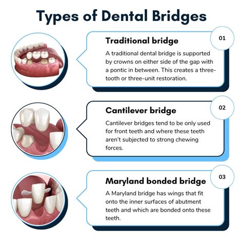 What is a Dental Bridge: Comprehensive Guide - Savannah Dental