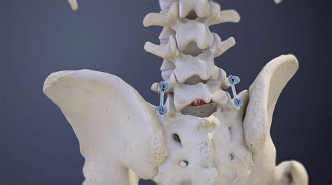 Understanding L5-S1 Spinal Fusion Animation