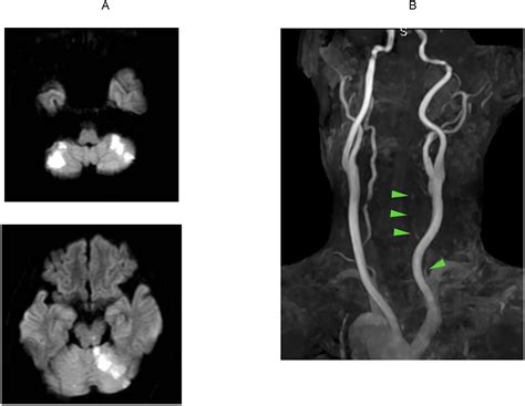 Treatment of rotational/positional vertebral artery occlusion due to degenerative changes in the ...