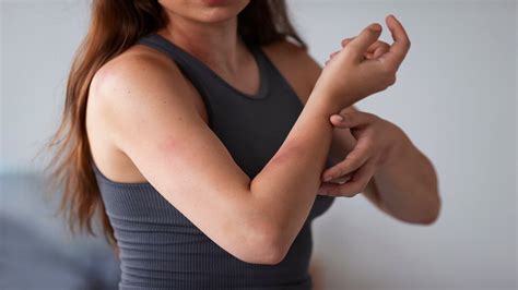 हीट रैश होने पर नहीं करनी चाहिए ये स्किन केयर मिसटेक्स | avoid these ...