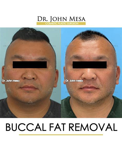 Buccal Fat Removal For Man at Pam Kirkland blog