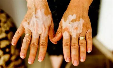 PCSK9 Inhibitors May Reduce Risk of Vitiligo,Promising New Therapeutic ...