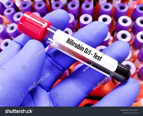 Blood Samples For Bilirubin at Anthony Sears blog