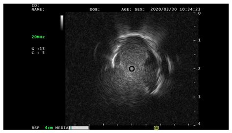 Peripheral Pulmonary Lesions Classification Using Endobronchial ...