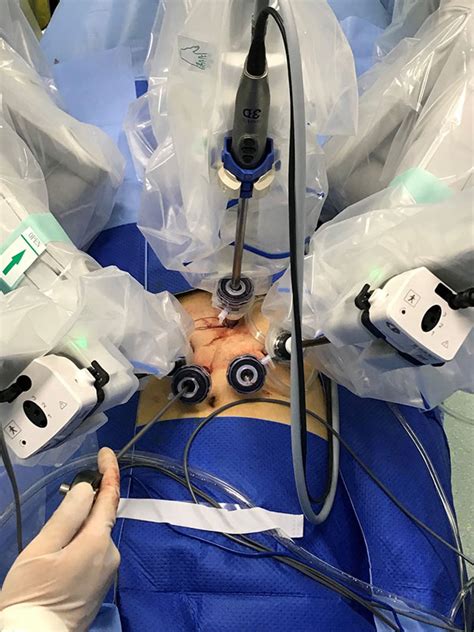 【医海撷英】我院首次应用国产手术机器人完成前列腺癌根治术 泌尿外科 -北京大学第一医院