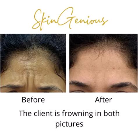 Best Botox Treatment in delhi with Latest Prices | Top Botox ...