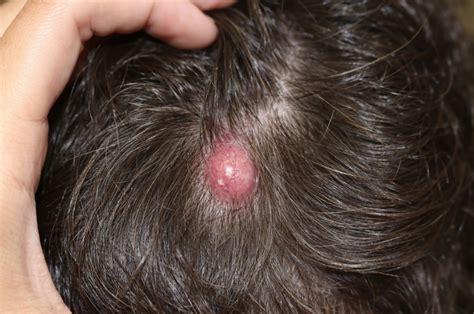 Growing Lumps Under the Skin: Causes, Types, and When to See a Doctor