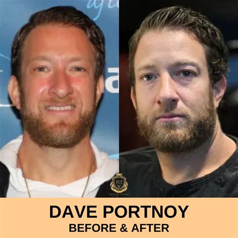 Dave Portnoy Hair Transplant