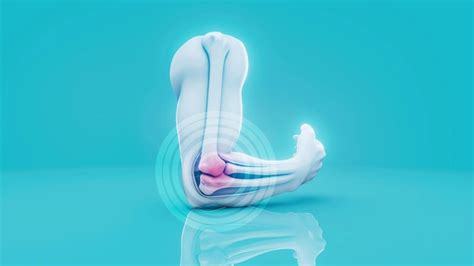 Conceptual 3d illustration of a tennis elbow inflammation | AI ...