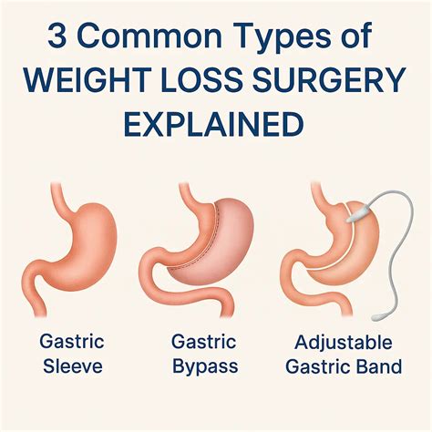 Types Of Gastrectomy Surgery
