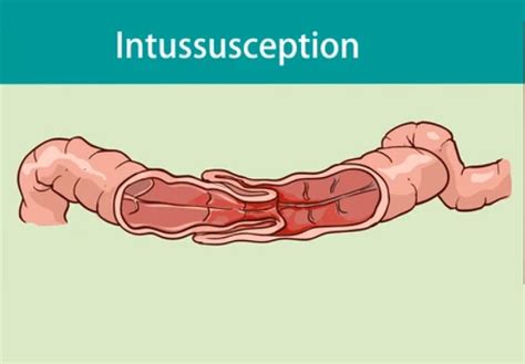 Image result for Intussusception Symptoms