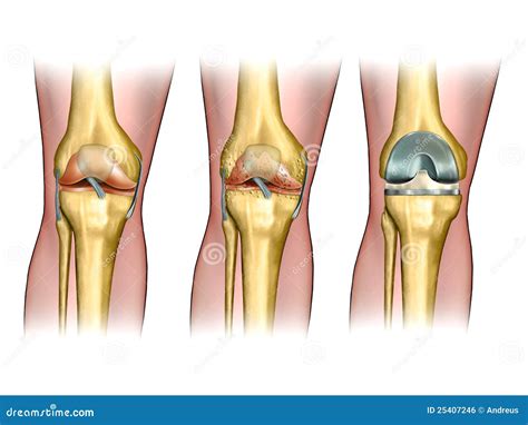 Knee replacement stock illustration. Illustration of anatomy - 25407246