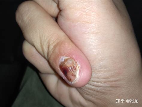 手指甲被夹到，过了一段时间，有黑色的淤血，怎么处理？ - 知乎