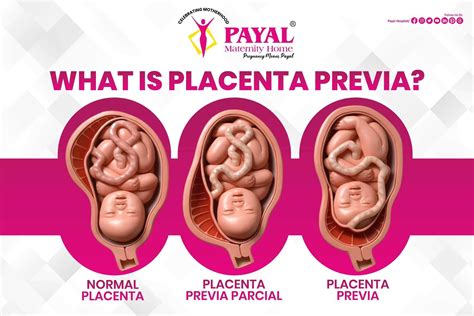 What is Placenta Previa? | Payal Maternity Home | Rajkot