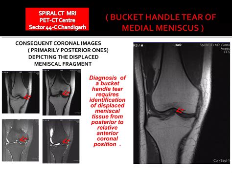 Bucket handle tear | PPT