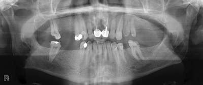Panoramic Dental X-rays - Dataset Ninja