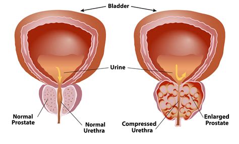 Benign Prostatic Hyperplasia (BPH) Signs and symptoms