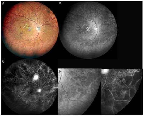 Progress of Imaging in Diabetic Retinopathy—From the Past to the Present