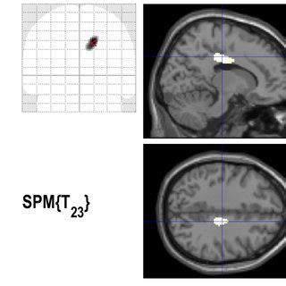 Statistical Parametric Mapping 的图像结果