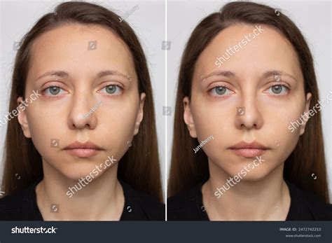 Стоковая фотография 2472742253: Collage Before After Plastic Surgery On | Shutterstock