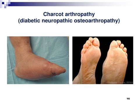 PPT - Diabetic Foot Evaluation PowerPoint Presentation, free download - ID:8770410