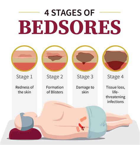 Bed Sores Grades at Martha Ehrlich blog