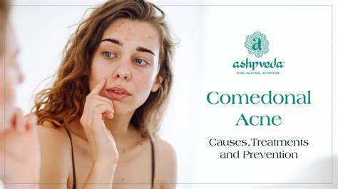 Comedonal Acne: Causes, Treatments & Ayurvedic Solutions | Ashpveda Guide