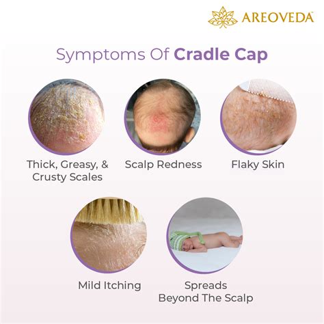 Cradle cap - Symptoms and causes – AreoVeda