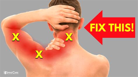 How to Instantly Relieve Nerve Pain in Your Neck and Arm | SpineCare