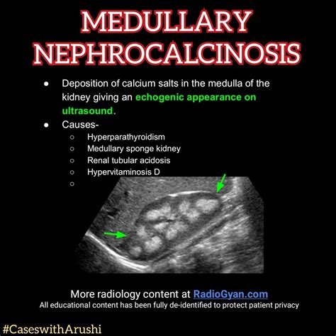 Medullary Sponge Kidney