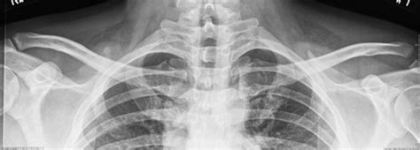 Image result for AC Step Defect