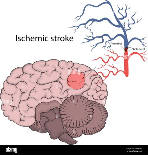 Vector illustration of ischemic stroke. Brain infarction Stock Vector Image & Art - Alamy