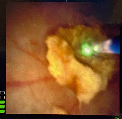 Ureteroscopy, Laser Lithotripsy, DJ Stent Insertion
