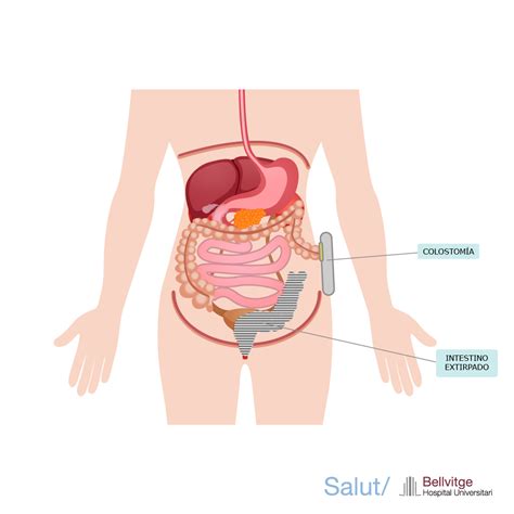 Ileostomía o colostomía: qué saber | Hospital de Bellvitge