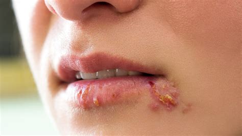 Herpes Simplex Symptoms In Women