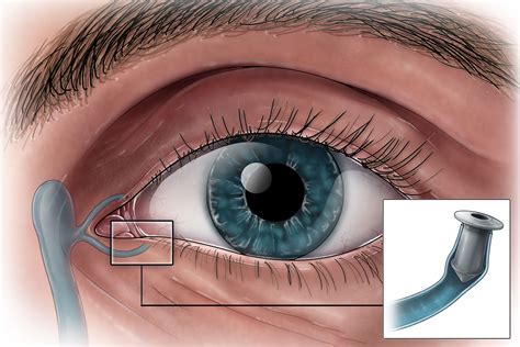 Dry Eyes After Punctal Plugs at Scott Sommer blog