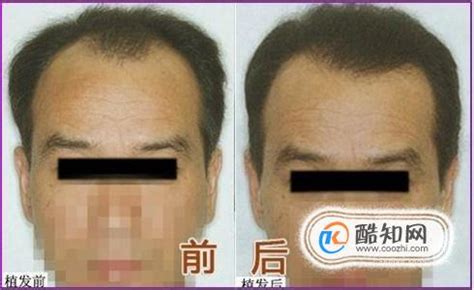FUT Hair Transplant Before After Photos and Results