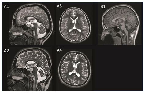 A Novel, Apparently Silent Variant in MFSD8 Causes Neuronal Ceroid ...