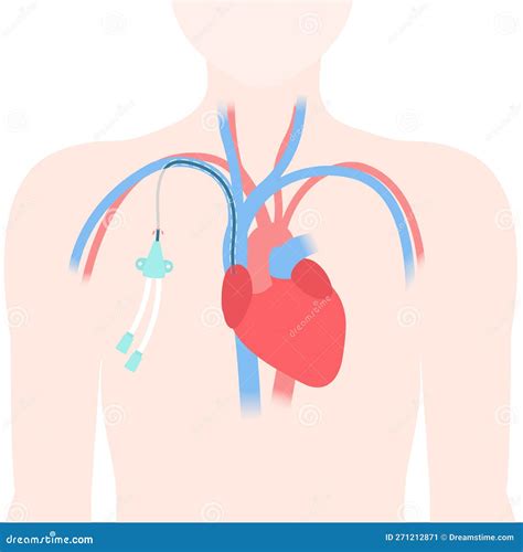 Tunneled Central Line Venous Catheter Medical Diagram Cartoon Vector | CartoonDealer.com #271212871