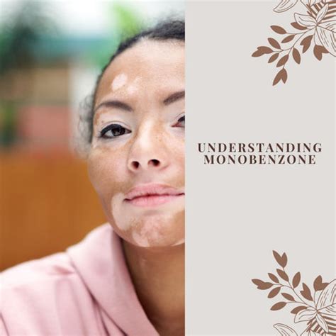 Monobenzone for Skin: Uses, Benefits, and Considerations | Clinikally