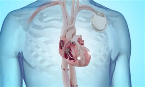 LBBP bests BiVP in Reducing Death or HF Hospitalization in LBBB with ...