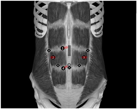 Opioid-Sparing Effect of Multi-Point Incision-Based Rectus Sheath Block ...