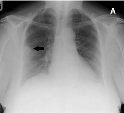Pulmonary Embolism X Ray Google Search Chest Pathology